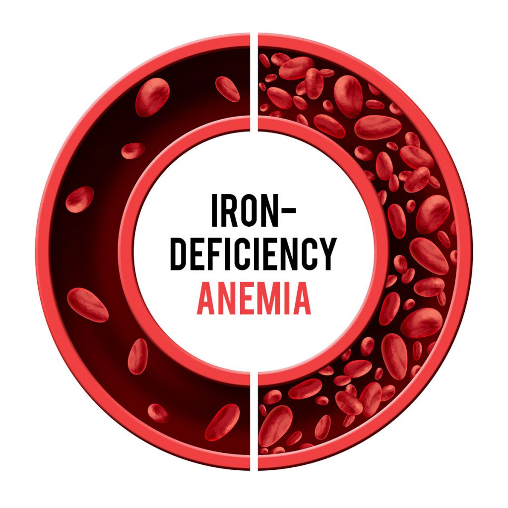 Iron deficiency anemia graphic of red blood cells