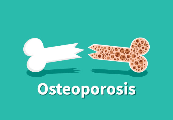 Untreated celiac disease can lead to impaired calcium absorption, bone loss and osteoporosis